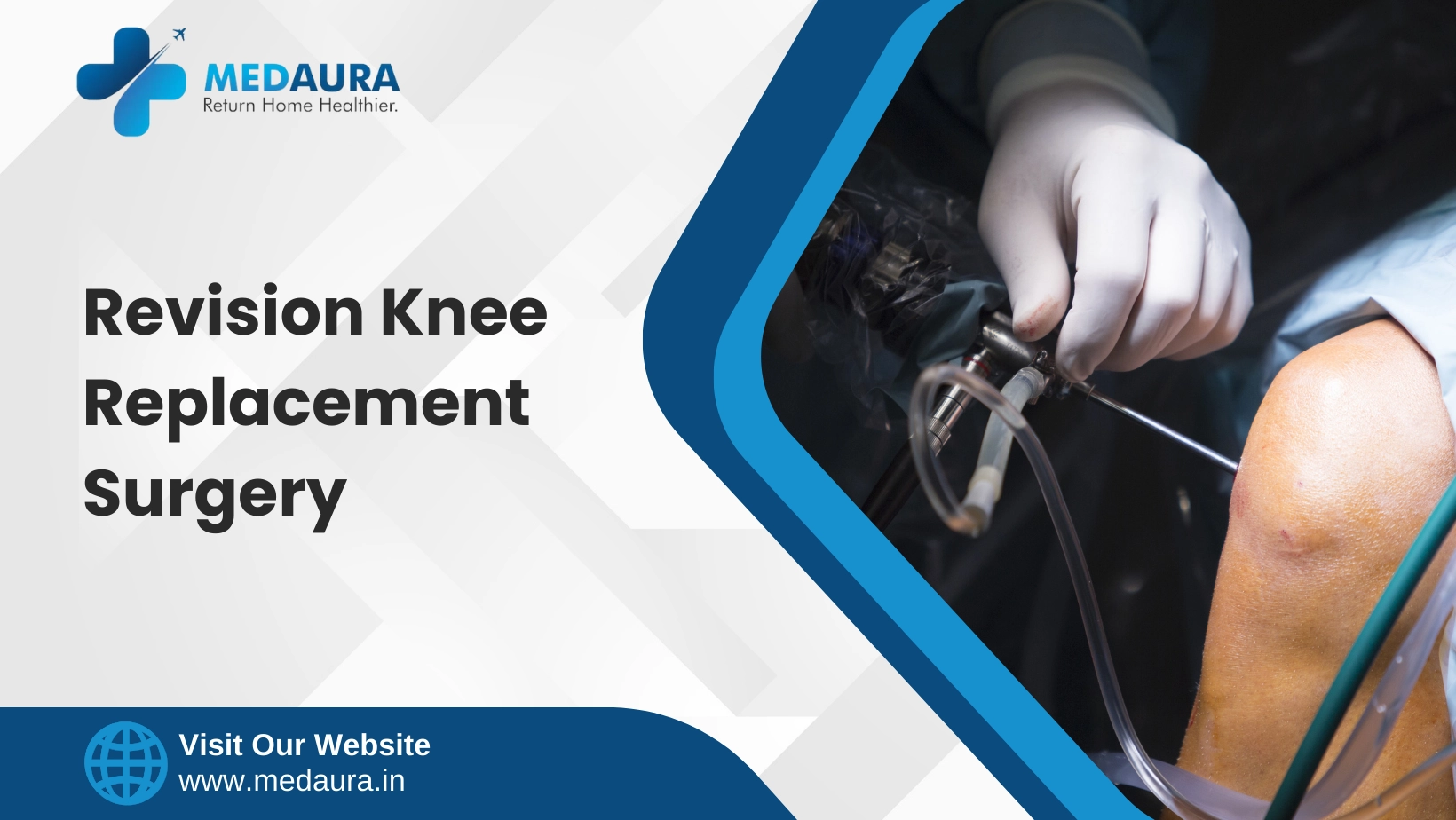 Revision Knee Replacement Surgery